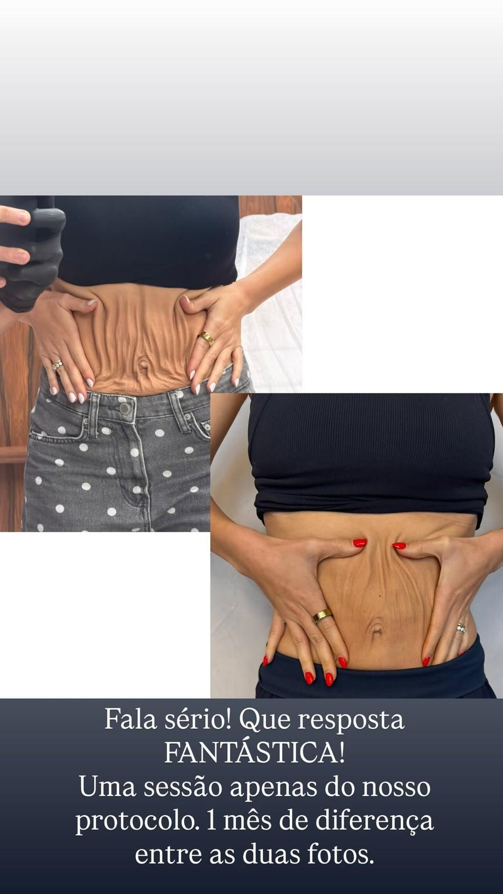 Um ms aps reclamar de barriga flcida e umbigo cado Lyandra Costa se surpreende com resultado de procedimento Foto ReproduoInstagram